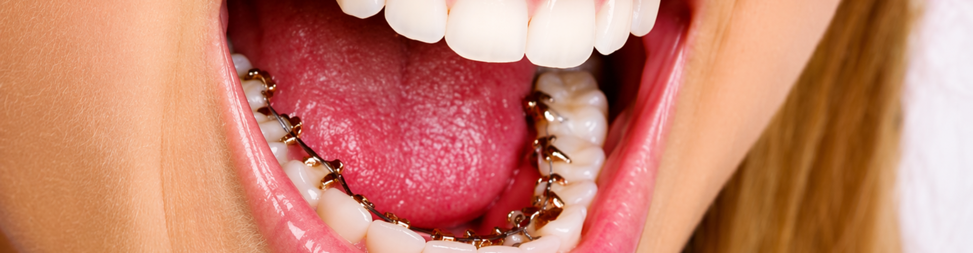 Woman opening her mouth to show braces on the back of her bottom teeth.